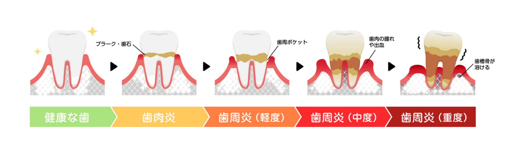 歯周病とは|やまもと歯科