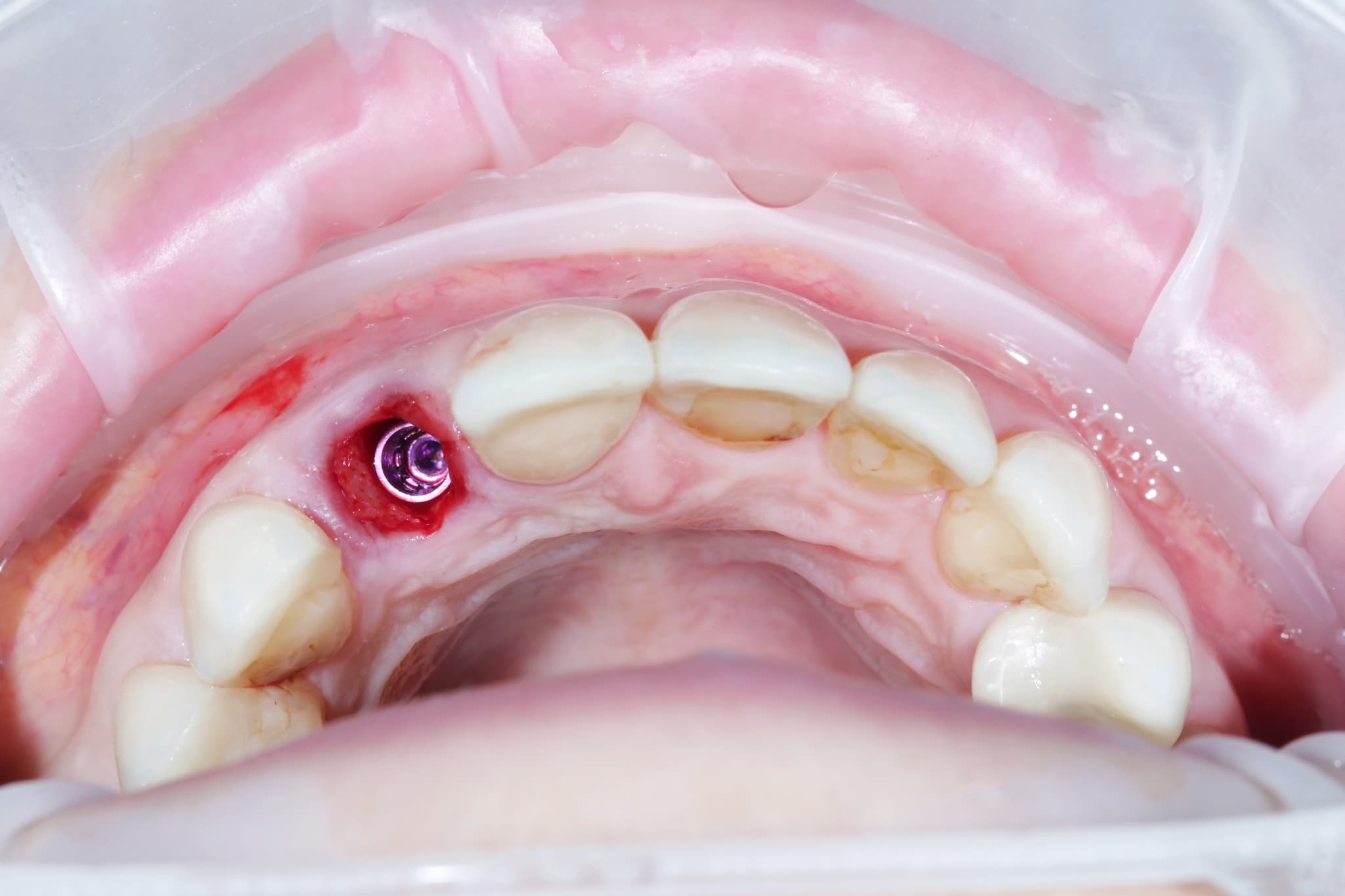 インプラント周囲炎になった歯茎