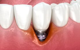 インプラント周囲炎のイメージ