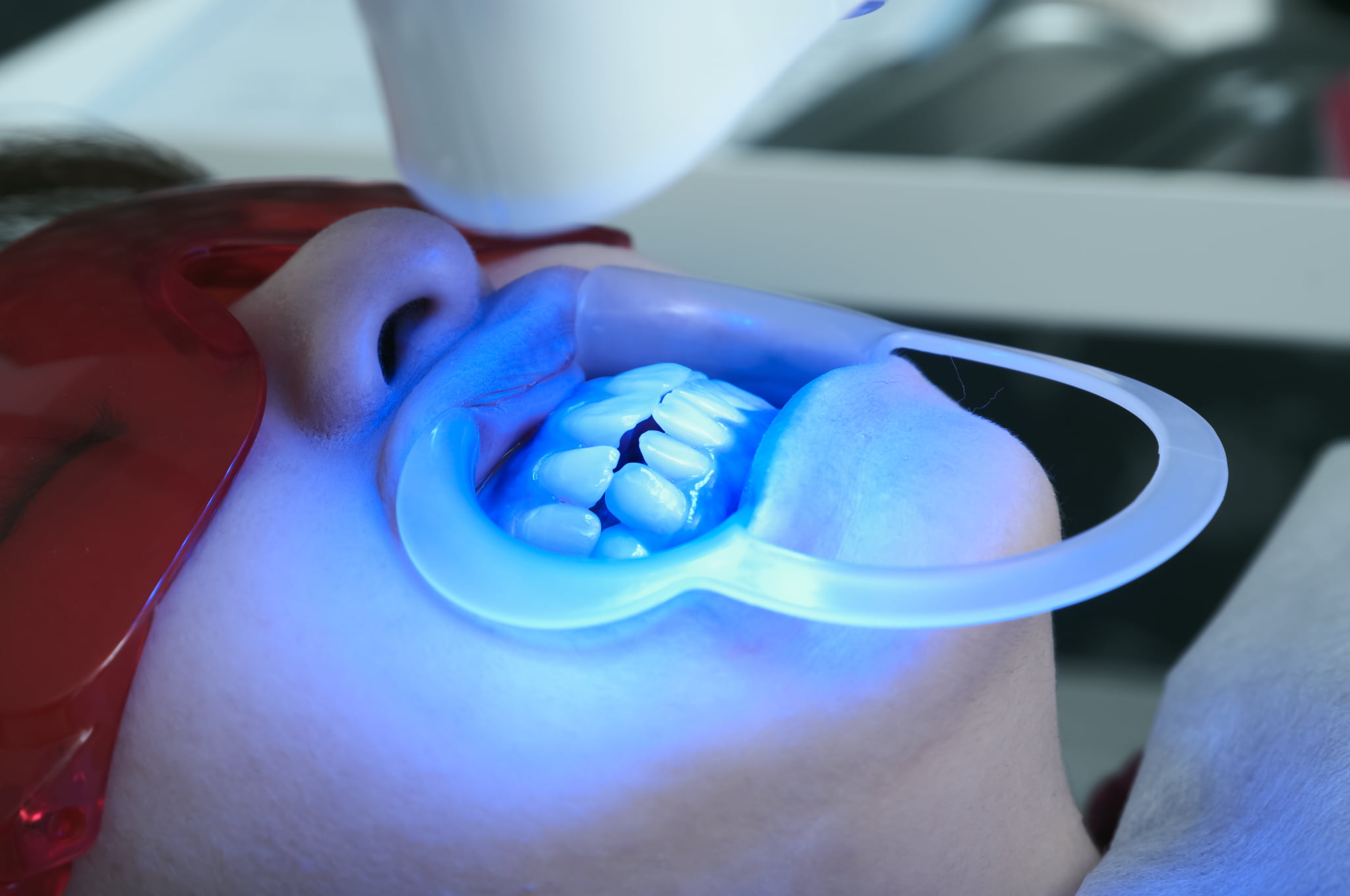 審美歯科治療の一つであるオフィスホワイトニングをする患者