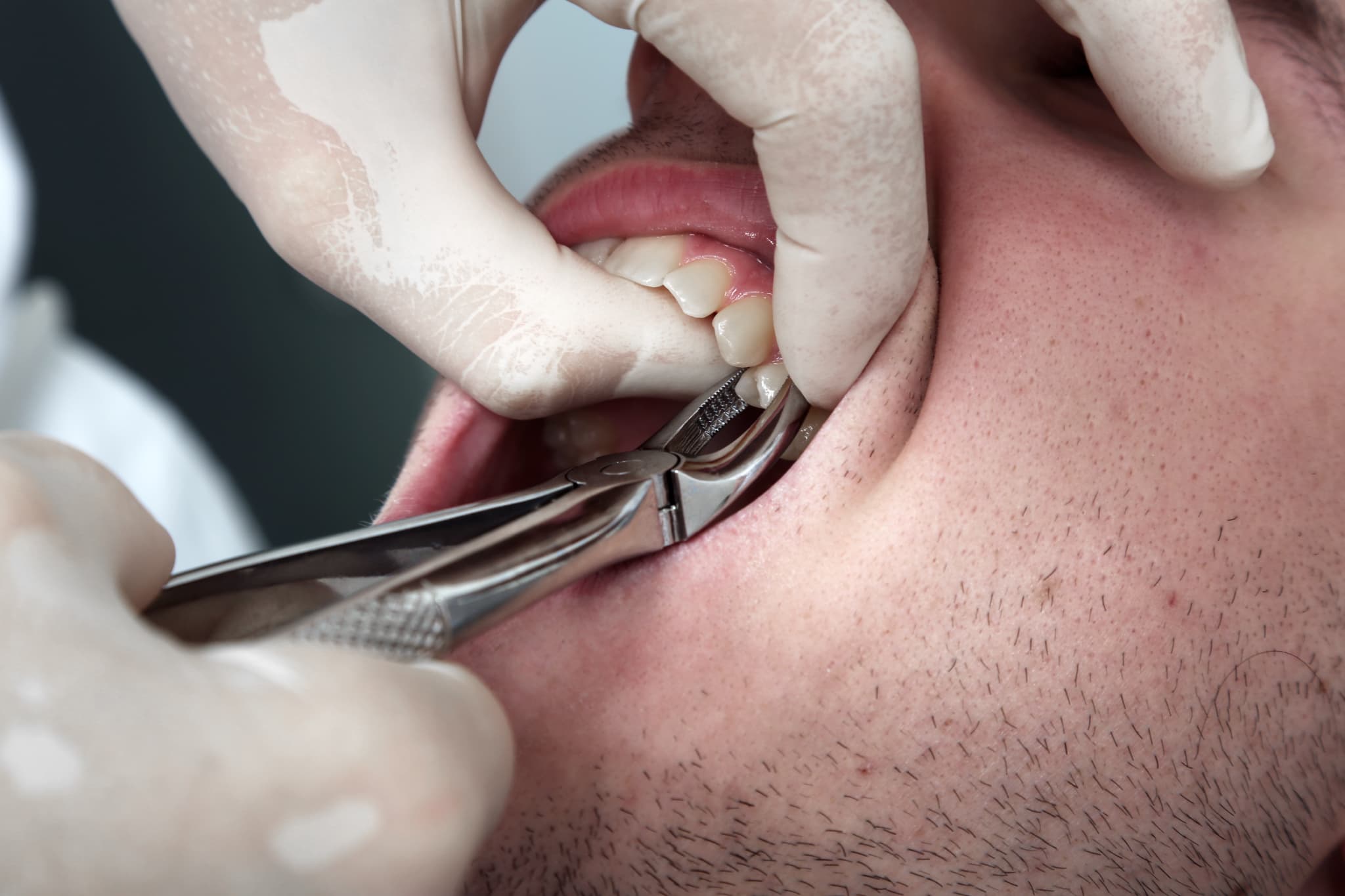 根管治療を中断したために抜歯が必要になった男性