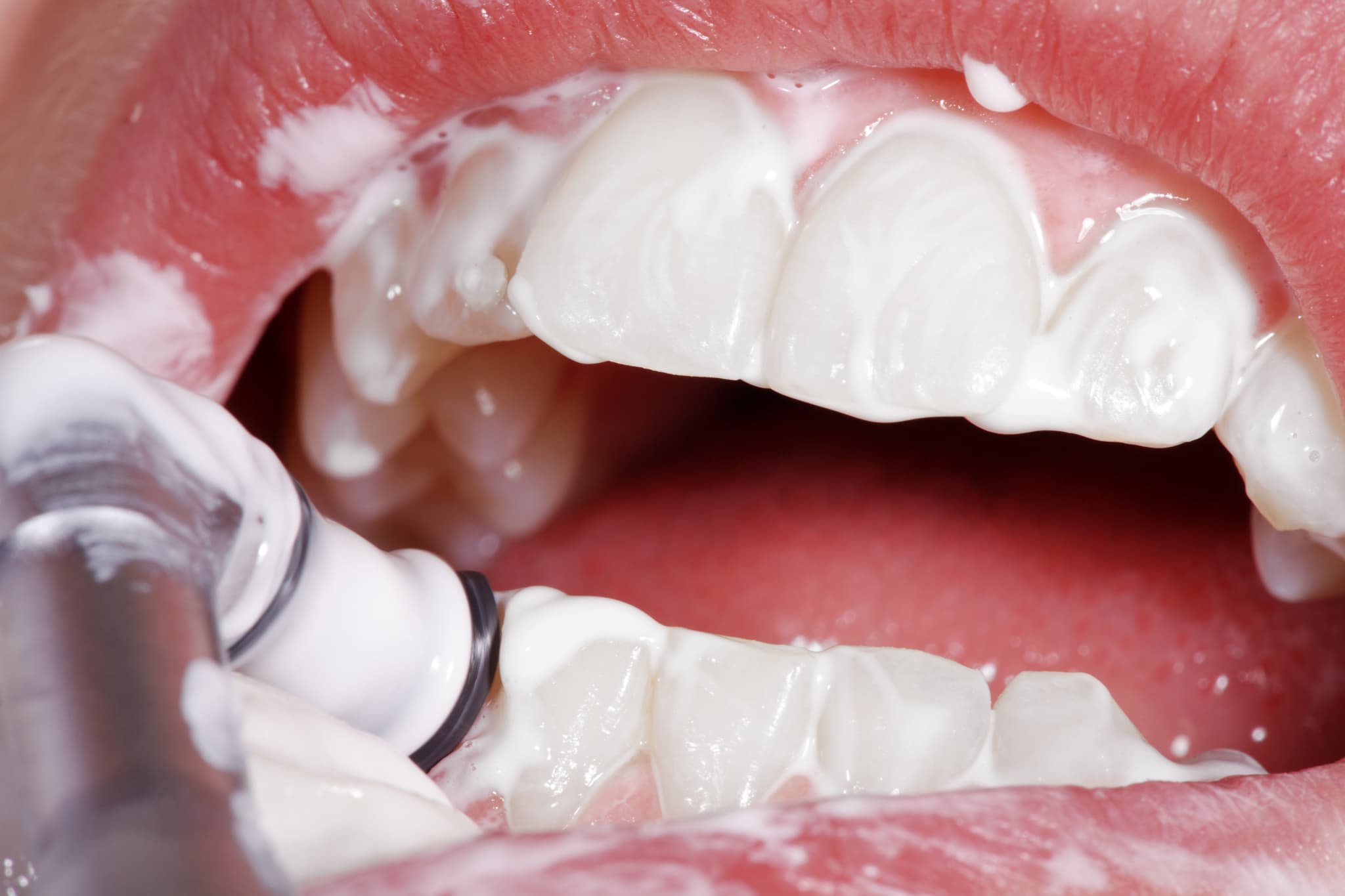 歯のクリーニングの様子