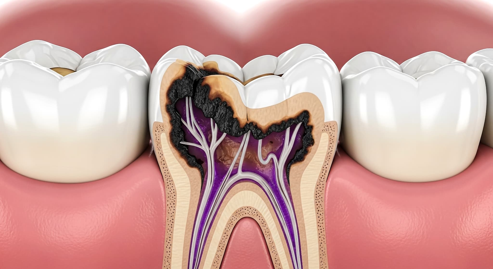 虫歯のメカニズムを説明するイメージ