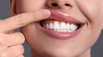 ラミネートニベアで治療した歯を見せる女性の口元