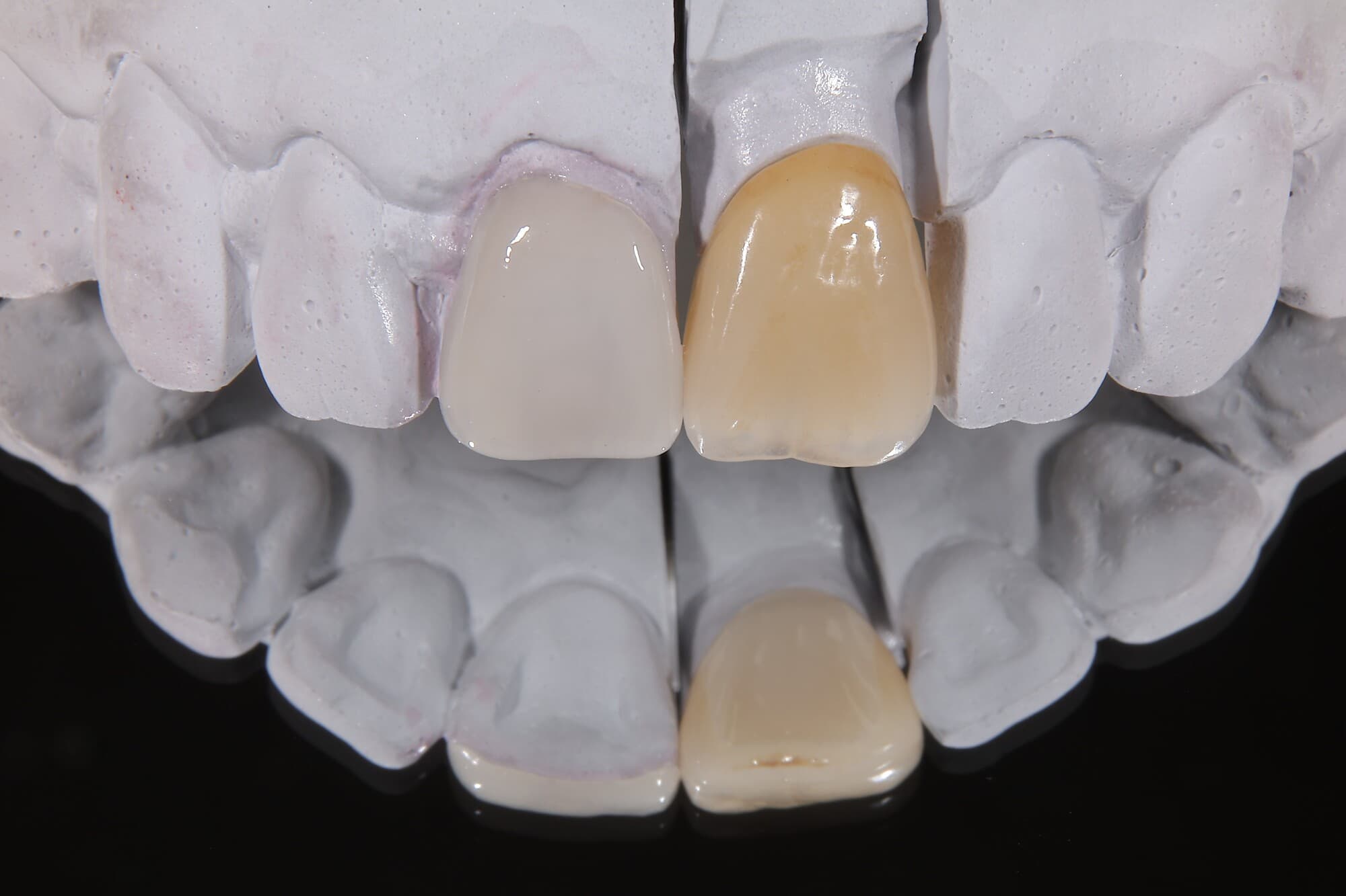 変色した前歯の被せ物