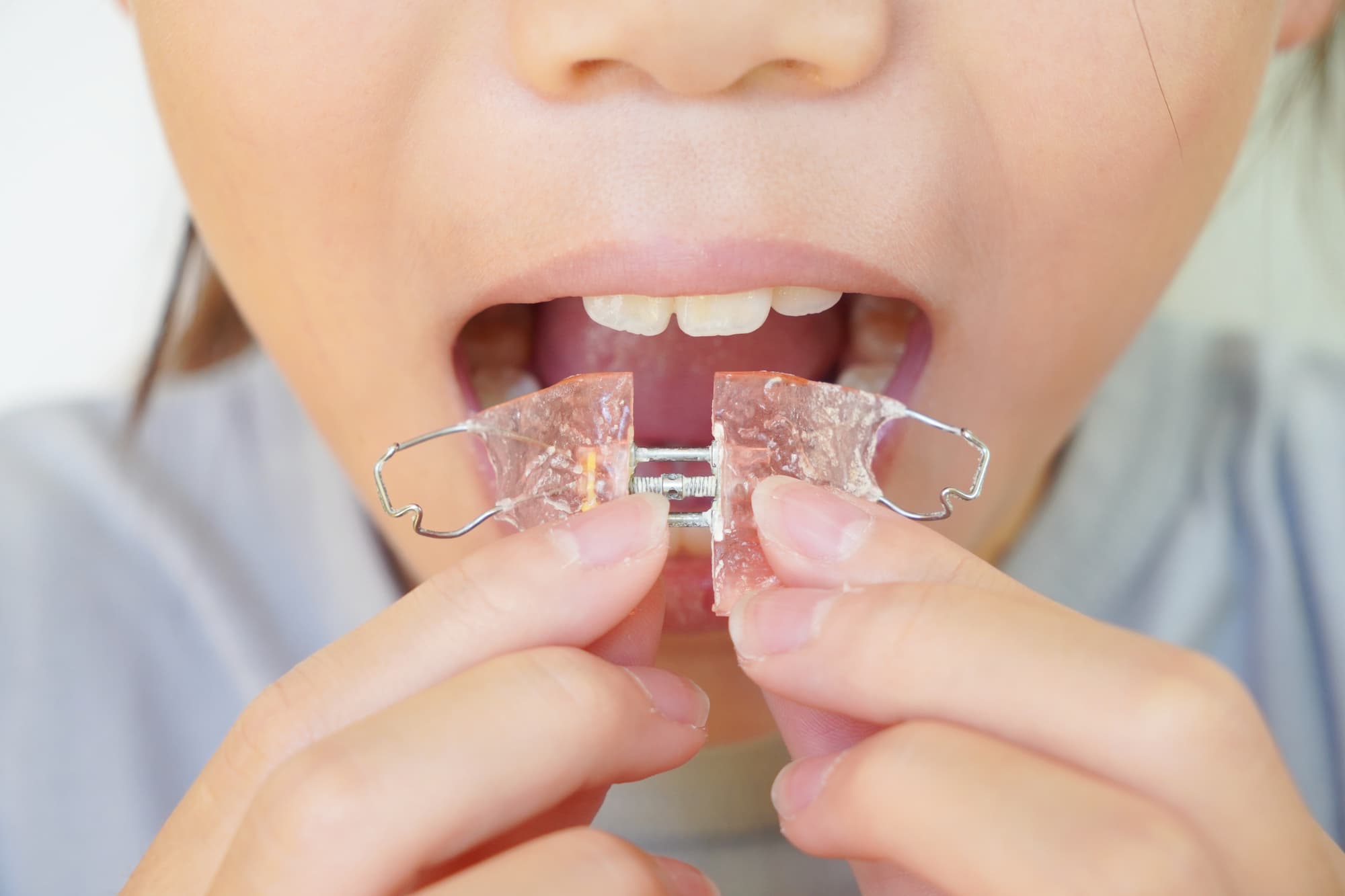 床矯正の装置を装着する子どもの口元