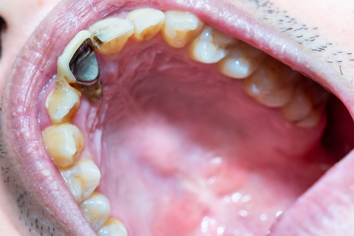 虫歯になっている前歯