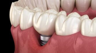 インプラント周囲炎で歯茎が黒ずんでいるイメージ