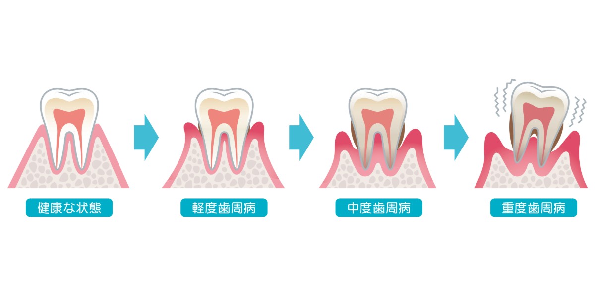 歯周病が進行する過程